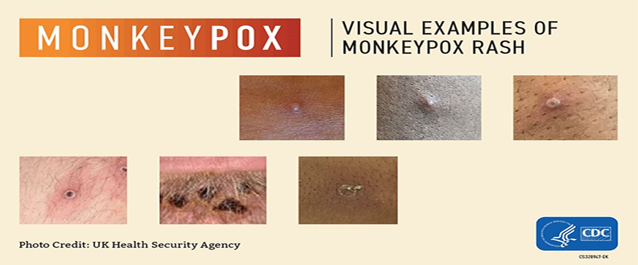 Monkeypox Images CDC